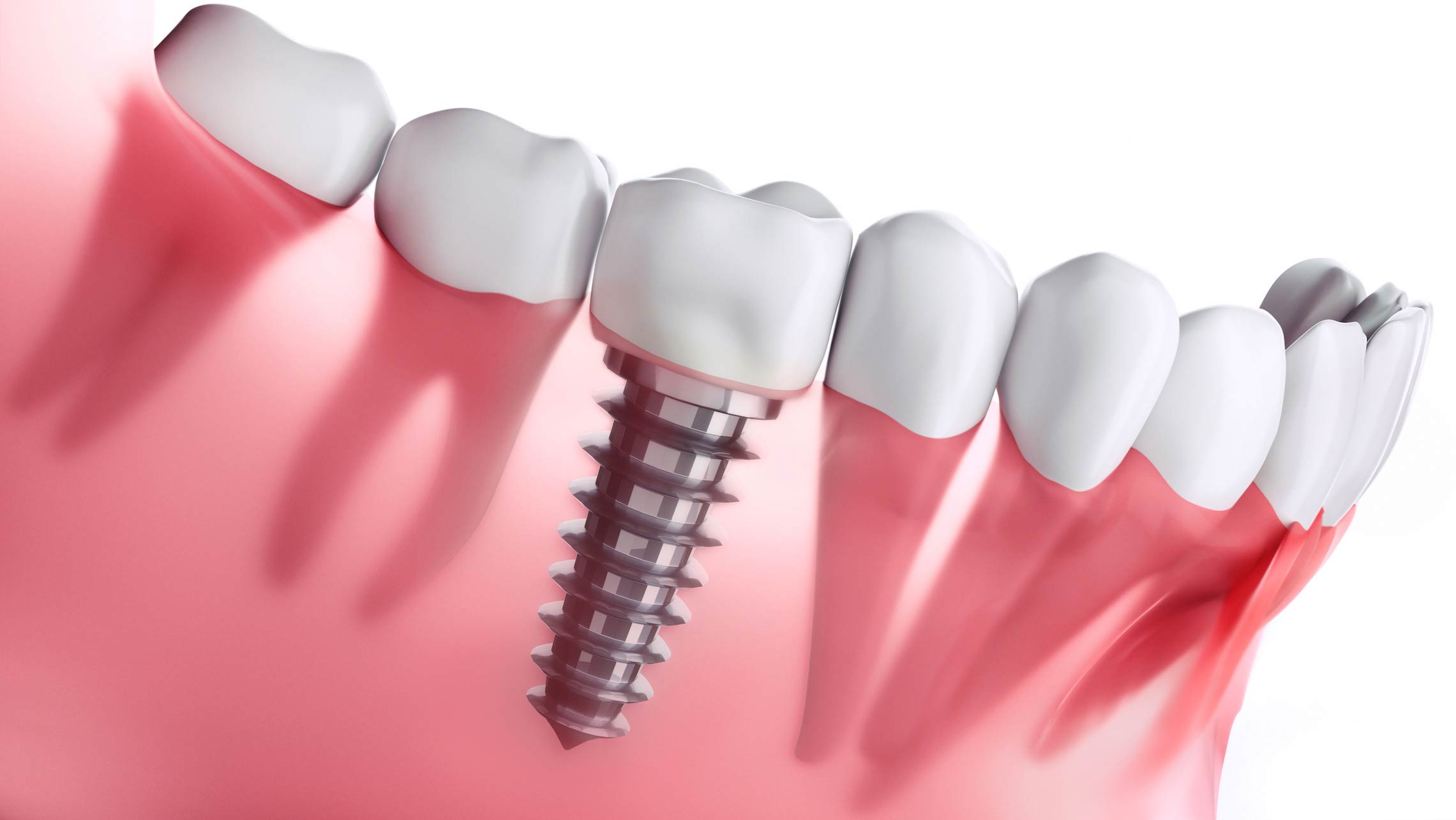 Teeth Implants